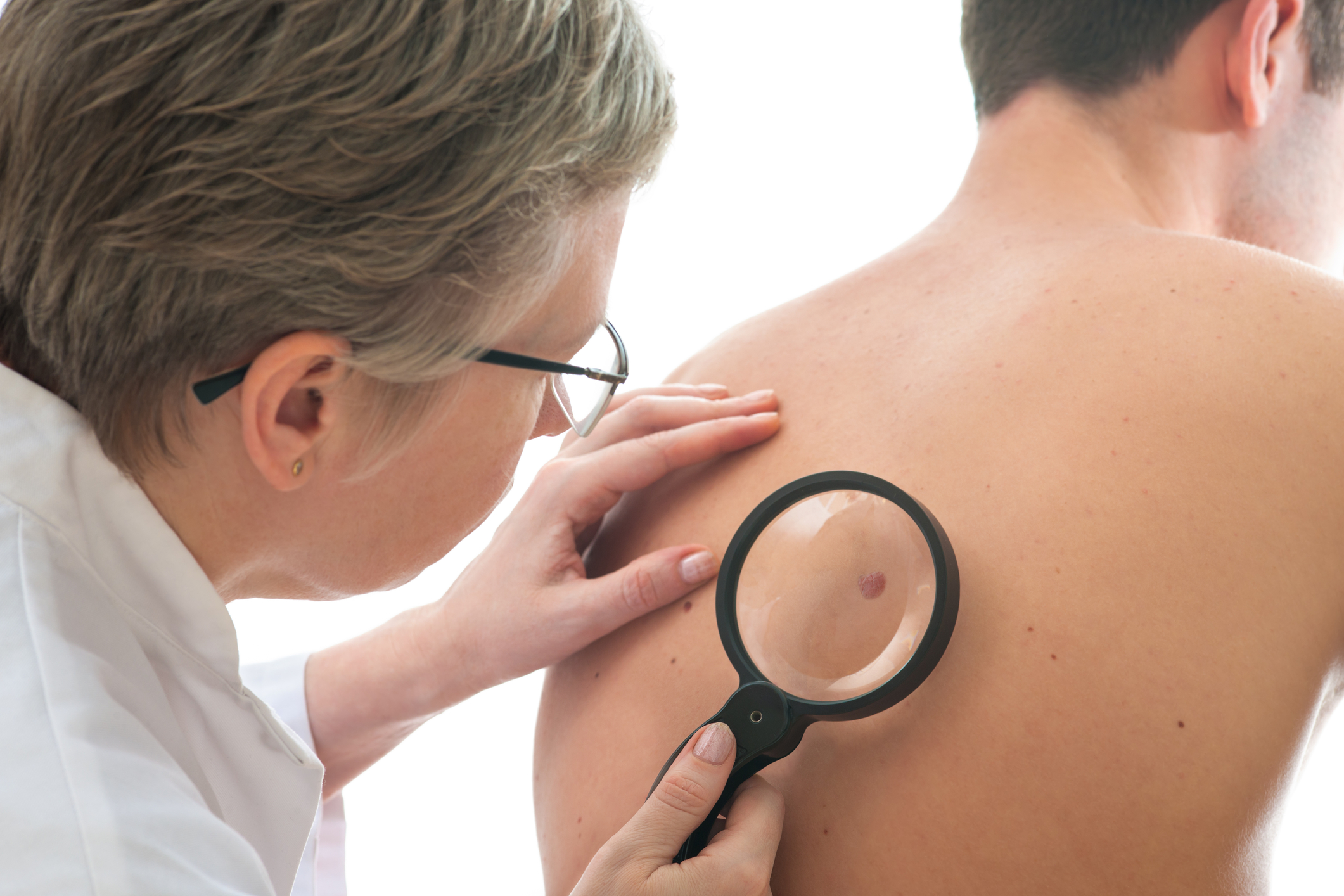The Link Between Moles and Melanoma