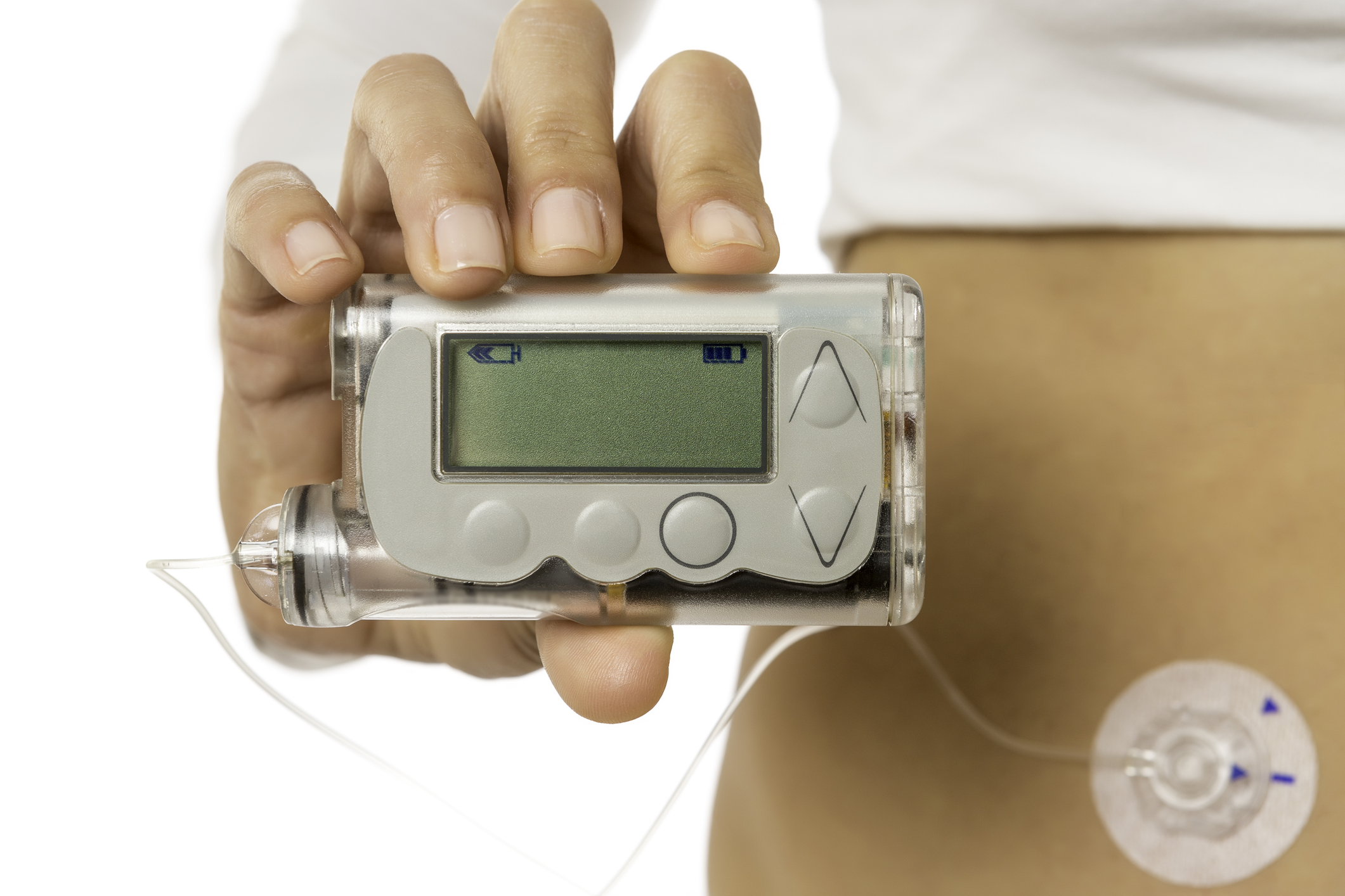 The Benefits of Insulin Pumps