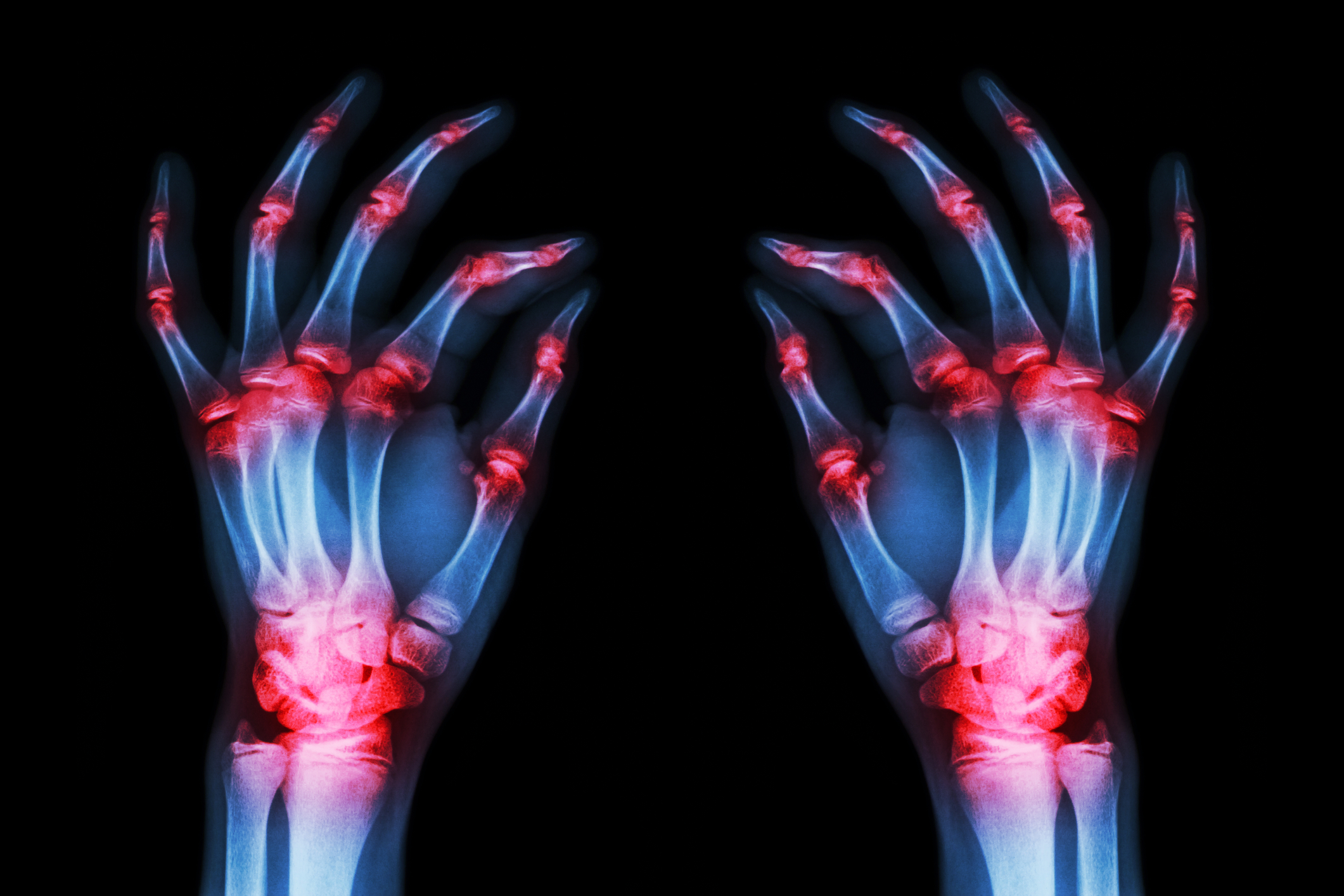 Good News for Rheumatoid Arthritis Treatment