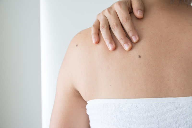 Companies Under Fire for Mole Removal Products