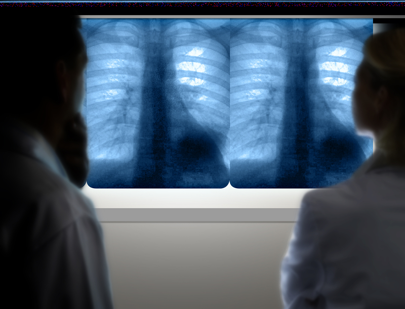 A Drop in Lung Cancer Deaths