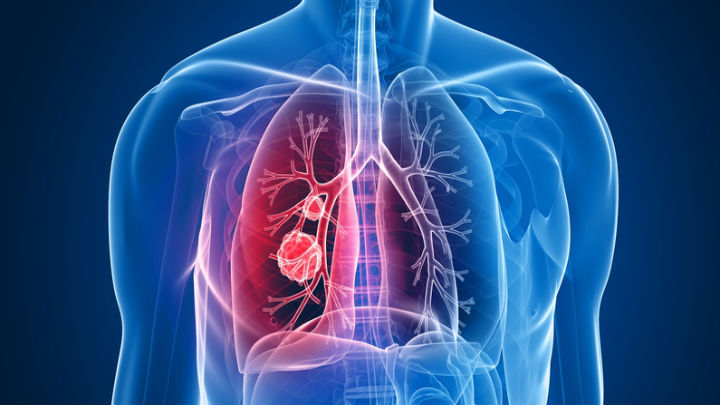 Lung Cancer Gets New Treatment
