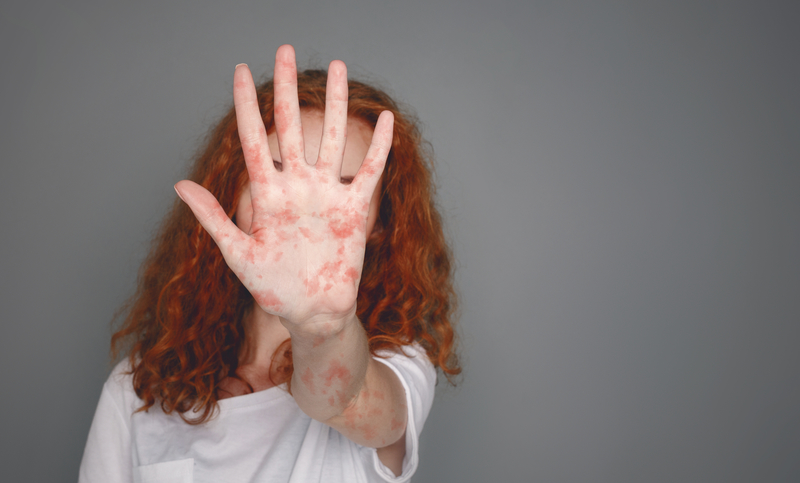 Measles in the US: Still Going Strong