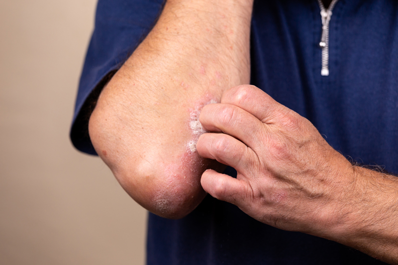 New Psoriasis Rx Gets Green Light