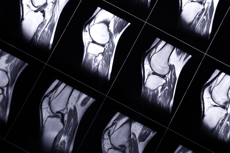 An Alternative to ACL Surgery?