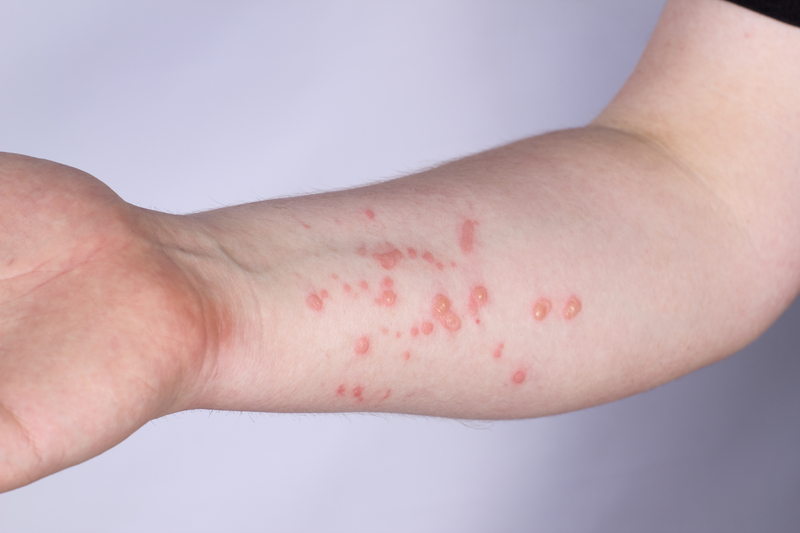 Monkeypox Testing: Everything You Need to Know