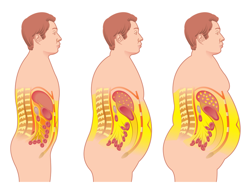 Obesity and Kidney Disease: What Some Don't Know
