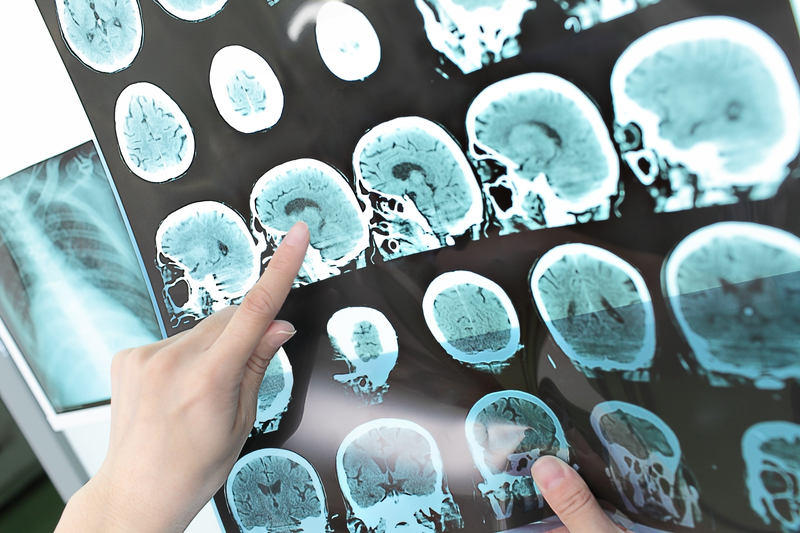 After Stroke, Time Matters