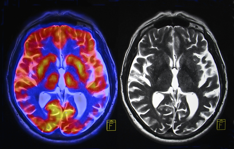 Menopause, Estrogen and Your Memory