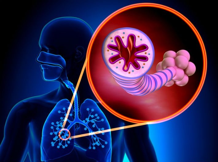 New Severe Asthma Rx Gets Green Light