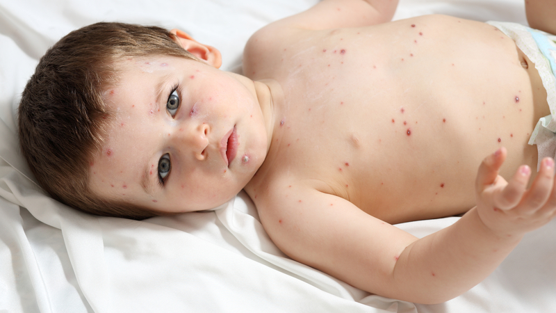 Chickenpox FAQ