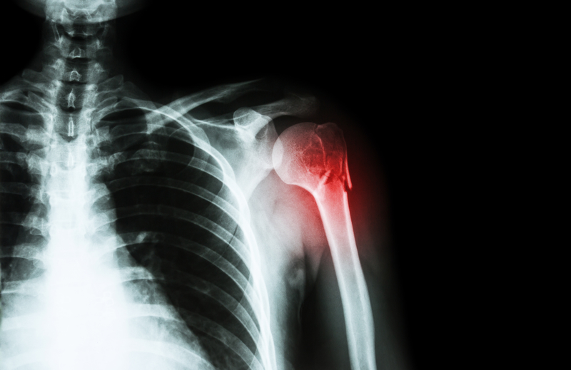 For Shoulder Dislocations, Surgery Might Help