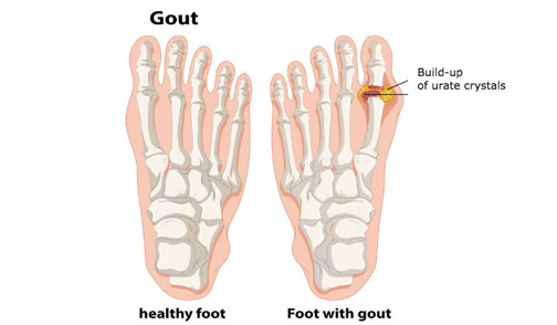 New Gout Combo Rx Approved