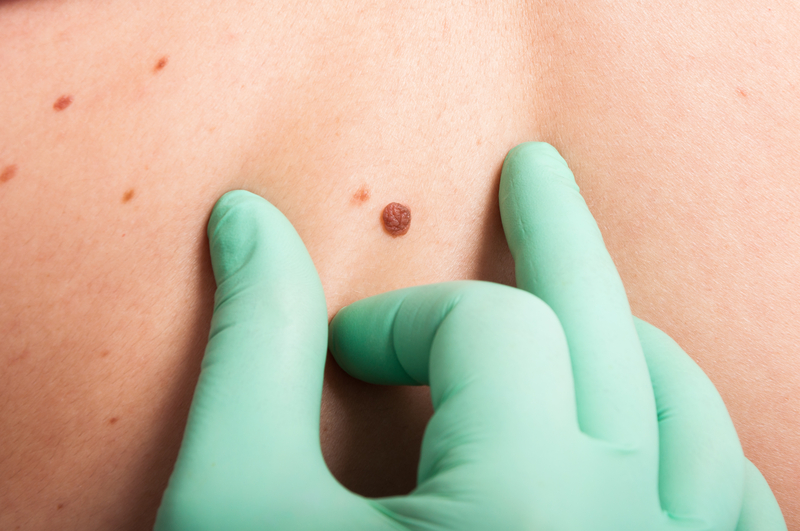 FDA: Mole Removal Products May Cause Harm
