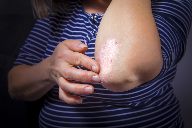 Psoriasis: Things to Know