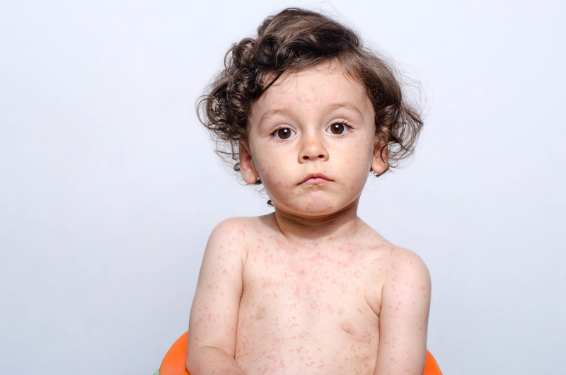 False Measles Outbreak Report Raises Concerns
