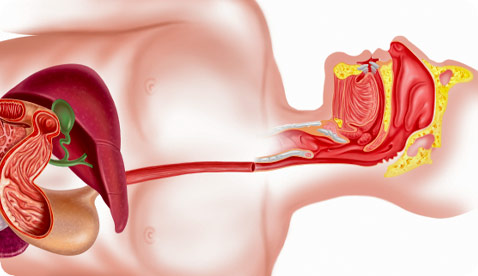 Esophageal Cancer on the Rise. Why?
