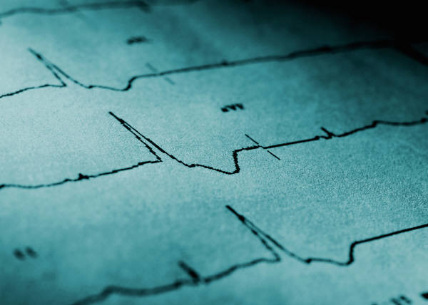 ECG: A Preventative Tool for the Heart?