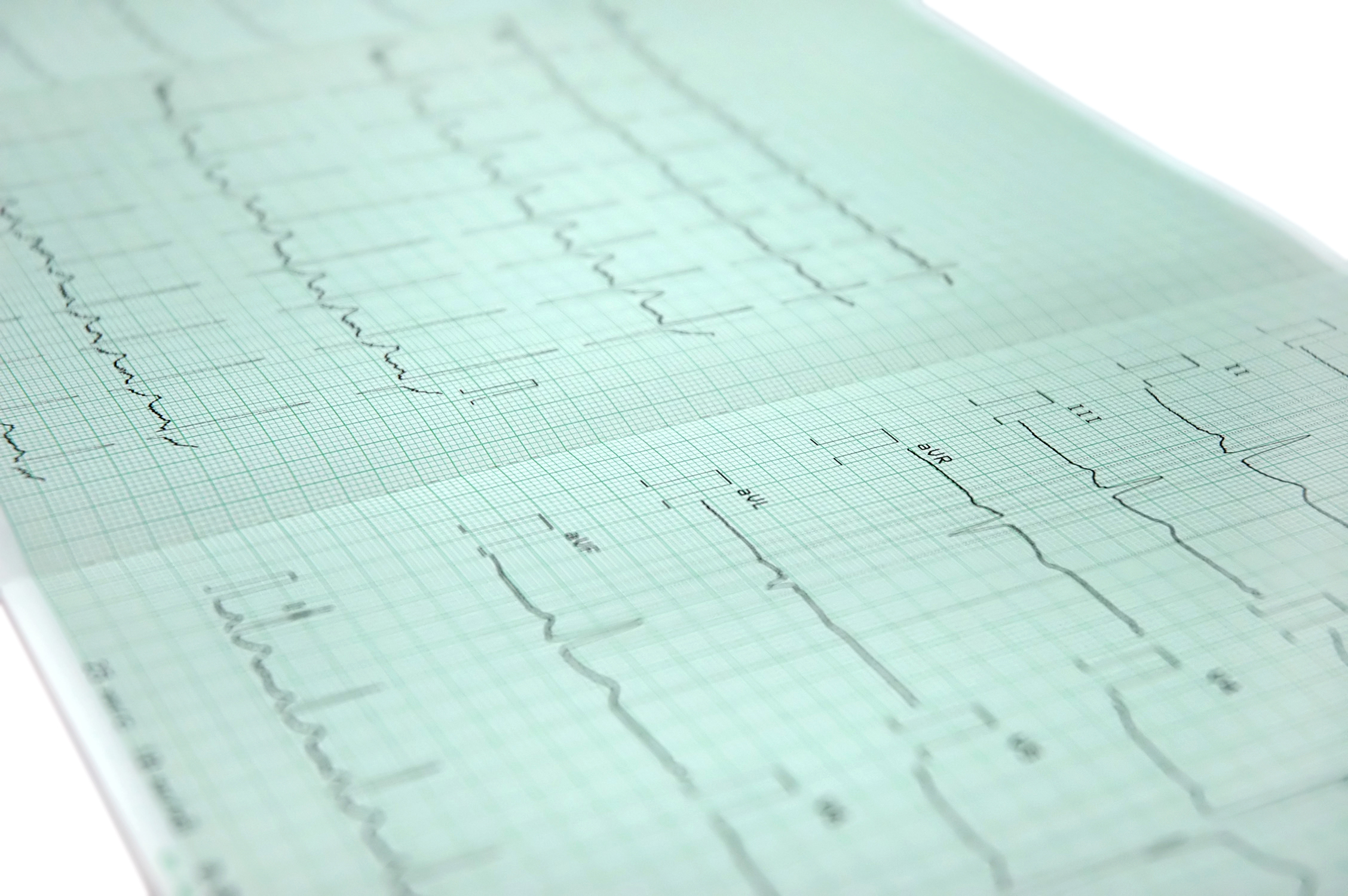 Heart Arrhythmia Linked to Cognitive Decline
