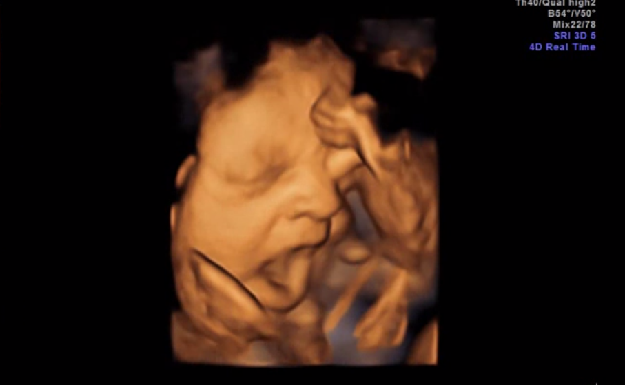 Babies Yawn in the Womb