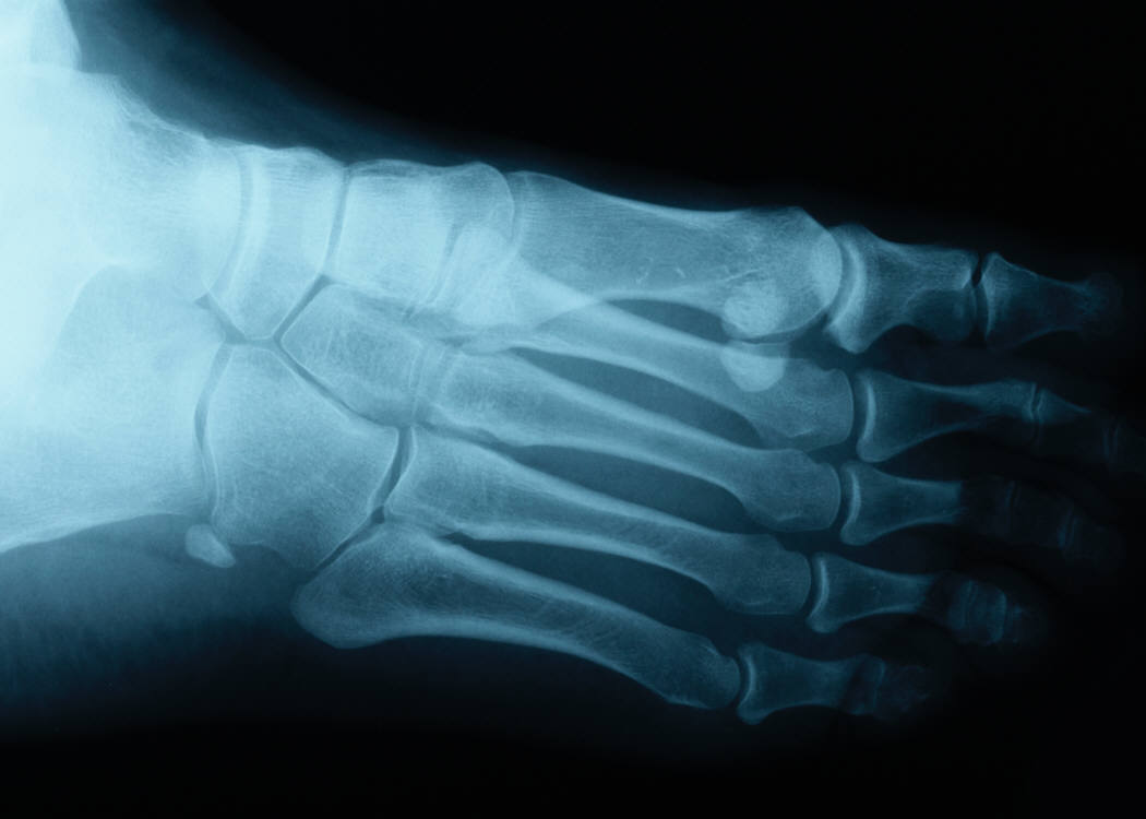 The "Dirty Dishes" of Gout