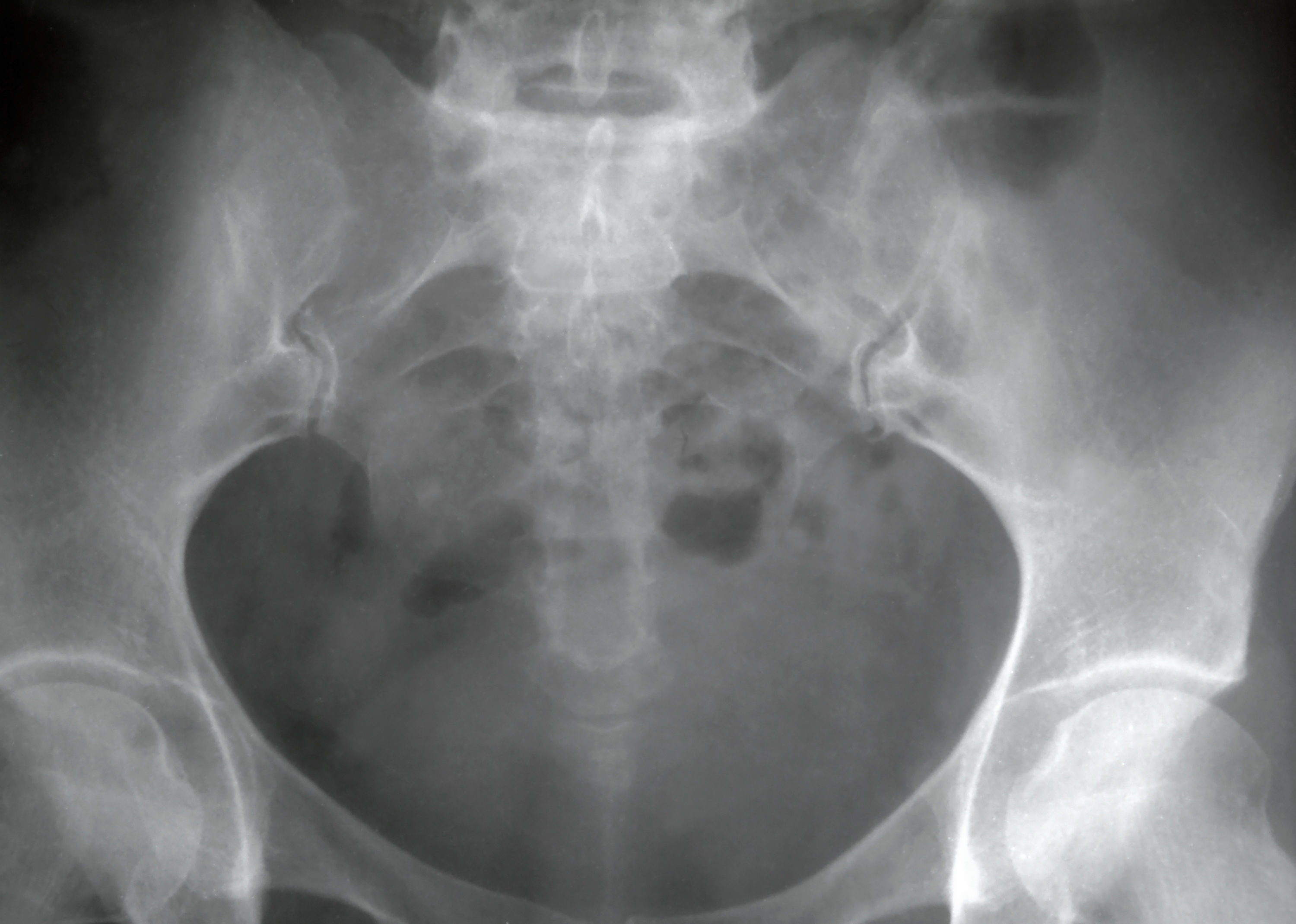 Prostate Therapy May Be Bad to the Bone