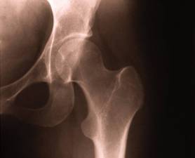 Rx Prevents Breast Cancer Survivor Bone Loss
