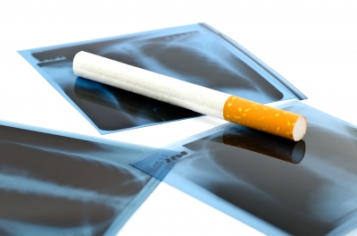 Helping Cancer Patients Quit Smoking