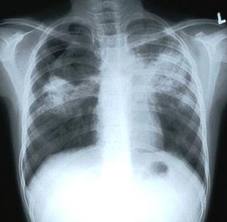 FDA Proposes Lower Risk Classification for Tuberculosis Testing