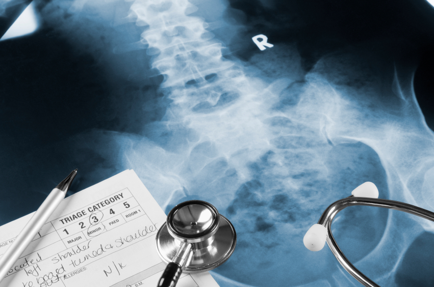 Bone Loss Common in AS Patients