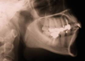 New Teeth in Oral Cancer Imaging