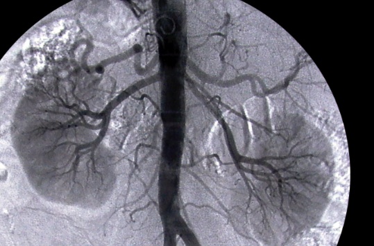 Why Care About Kidneys?