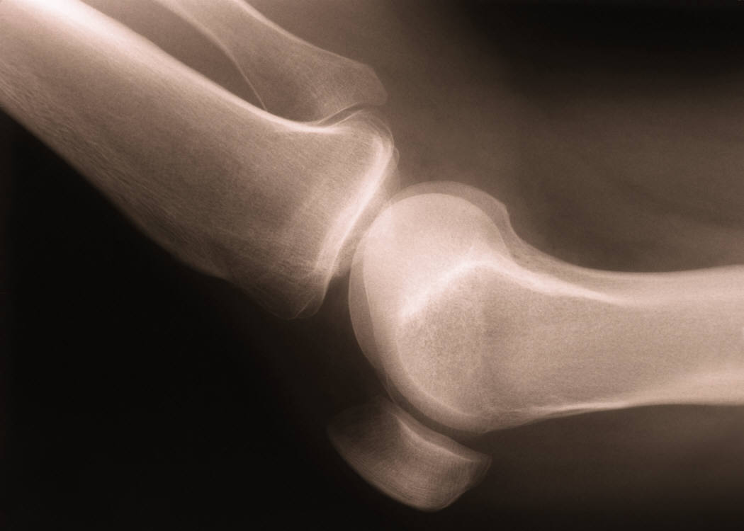 Heart Attack After Joint Replacement
