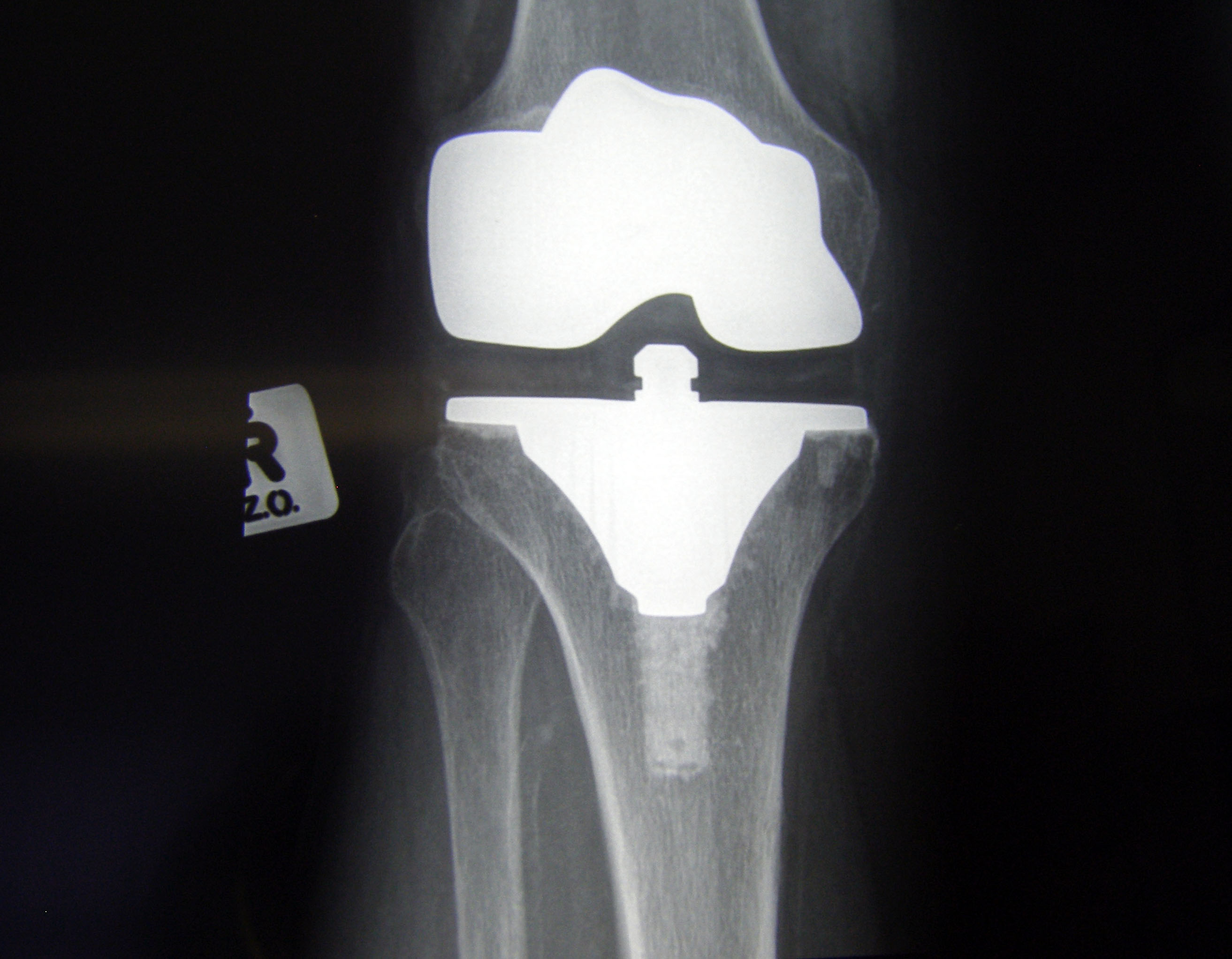 Long Live Knee Replacements in the Young!