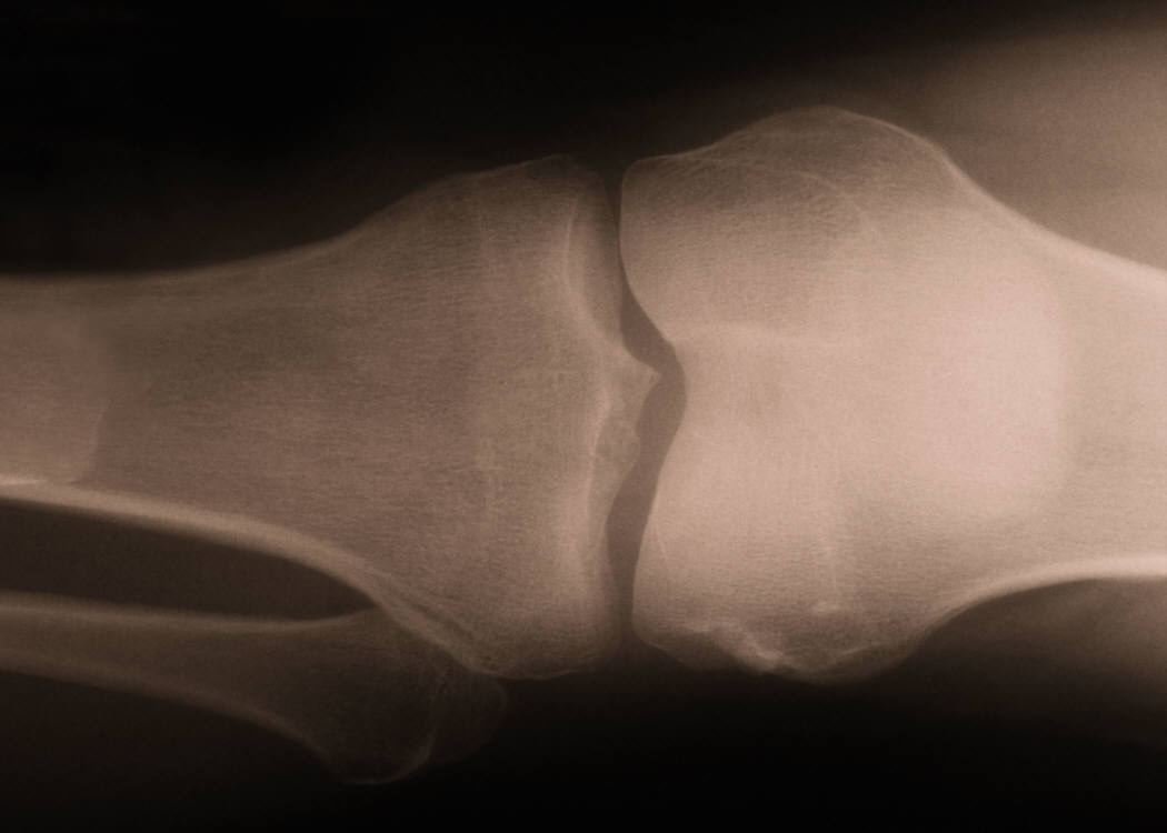 Weight Gain Produces Knee Pain