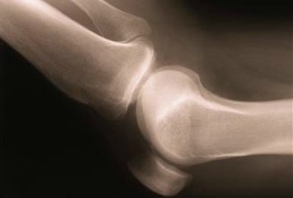 Granny's Knee Hurts
