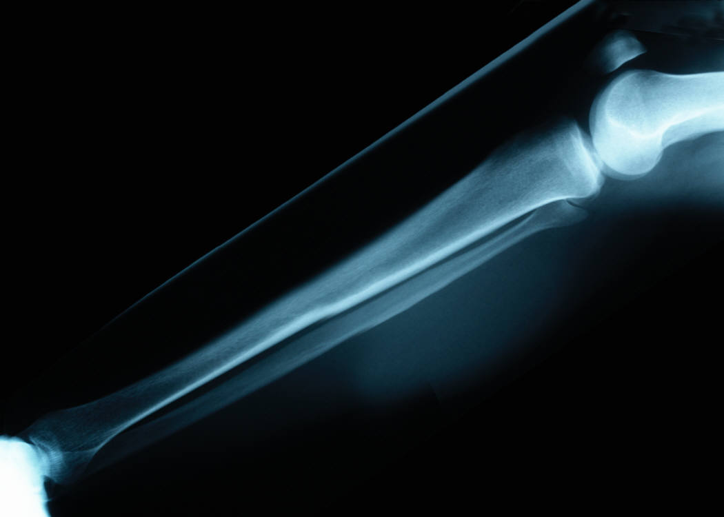 Finding Arthritis with Sound