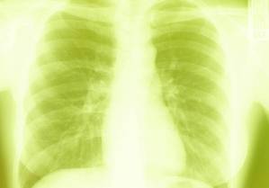 Gene That Drives Lung Cancer Discovered