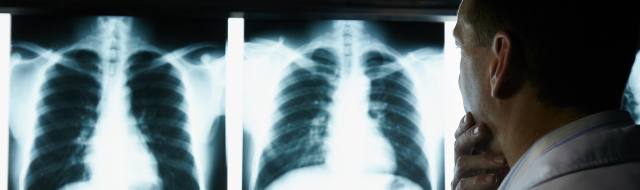 Why Lung Cancer is So Common and Who's at Risk