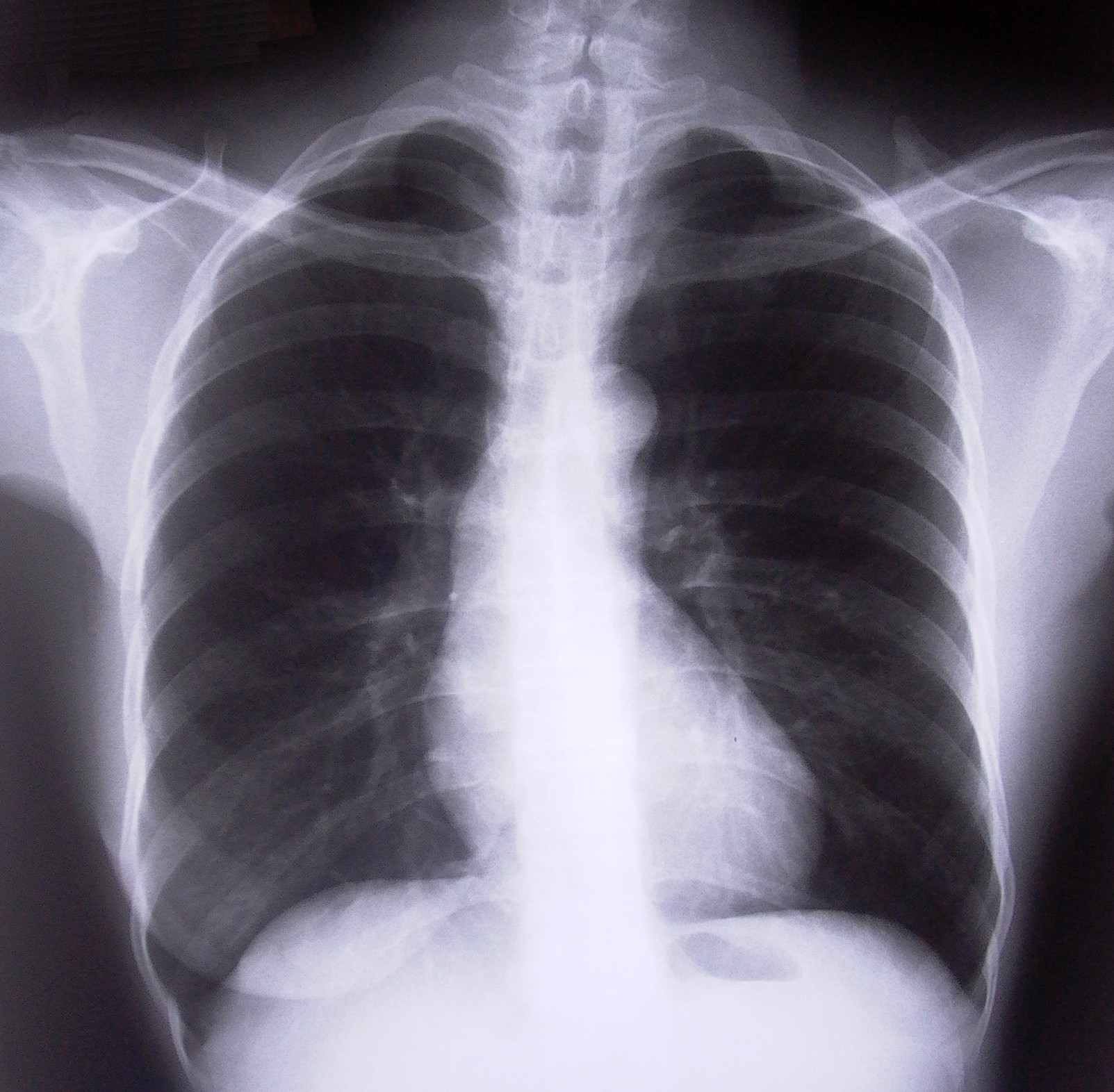 Lung Disease Double Whammy