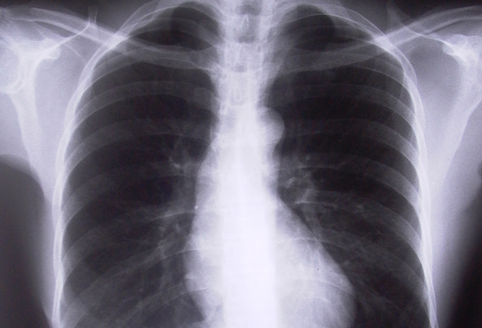 New Drug for COPD Symptoms