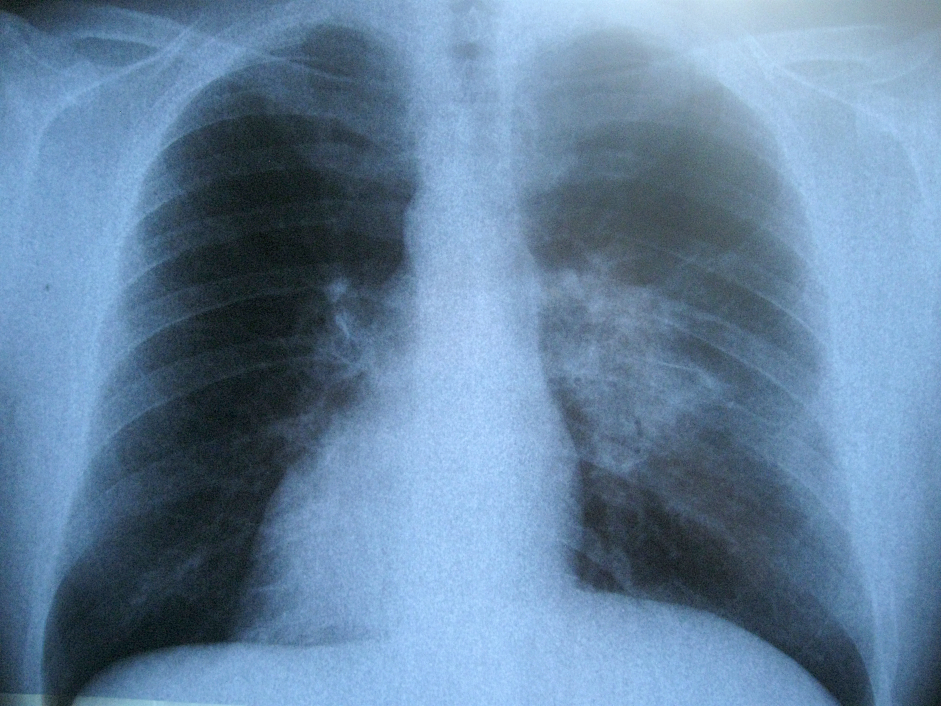 Better Scope for Lung Disease Diagnosis