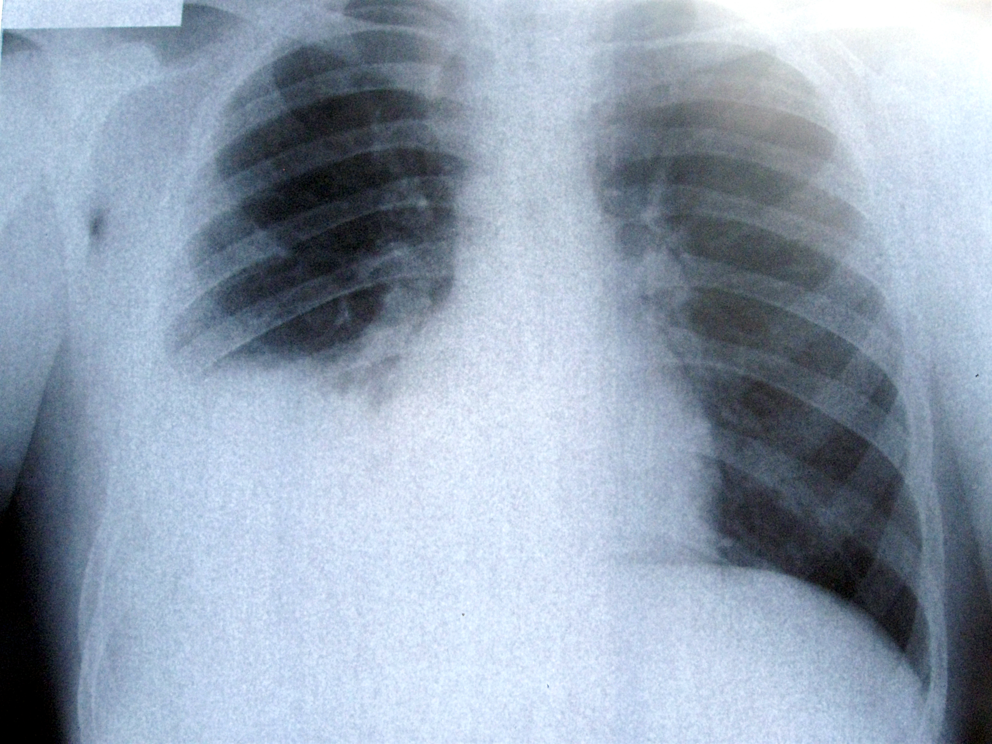 Good Old X-Rays For Spotting Lung Cancer 