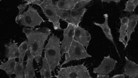 Anti-Seizure Drugs Slow Deadly Eye Cancer