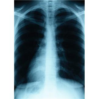 Lung Cancer, More Than Meets the Eye