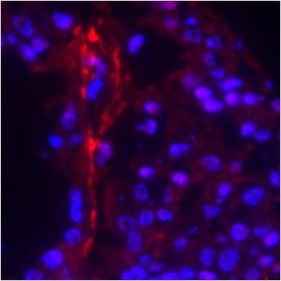 Study Finds Genetic Link Between Misery and Death