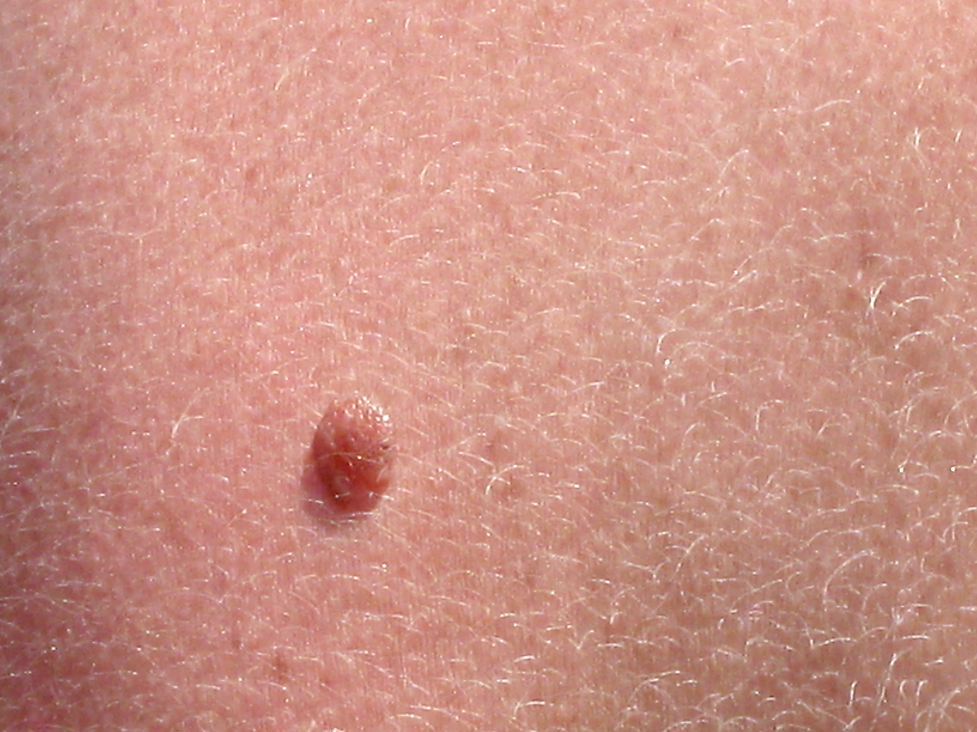 Melanoma Therapy Triggers Killing Machine