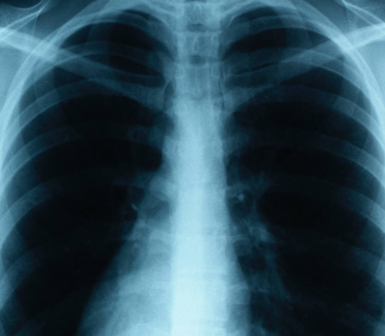 Women With CF Have Shorter Life Spans