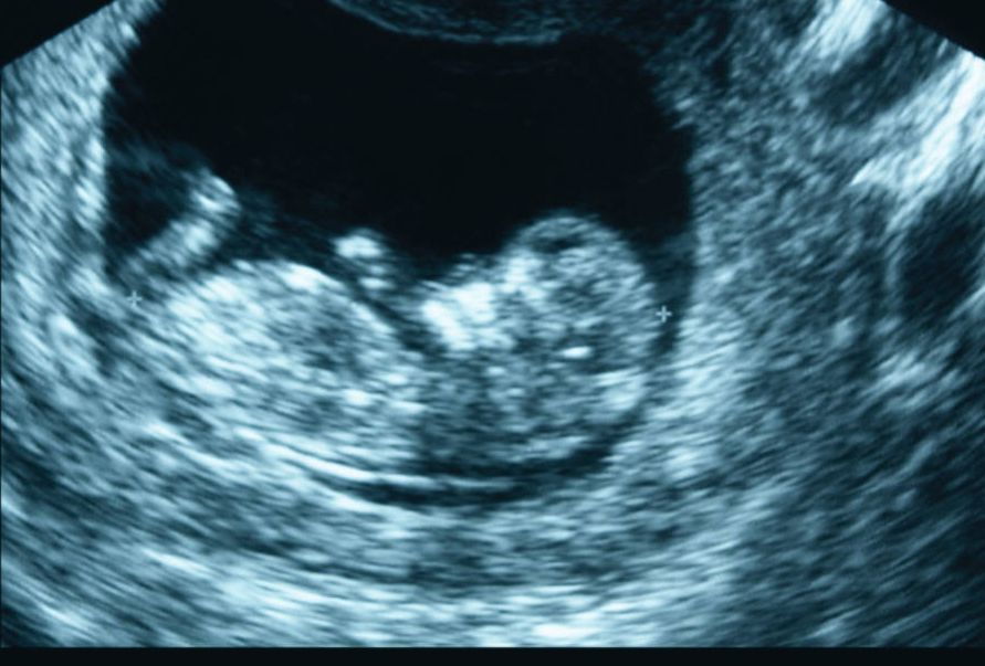 Reading the Future in Placenta Cells?