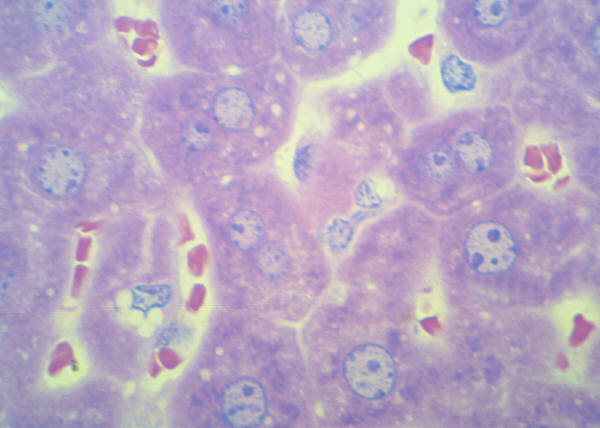 Fibroblasts Make a Big Noise in Cancer Research